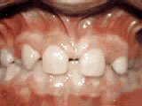 missing lateral incisors - before